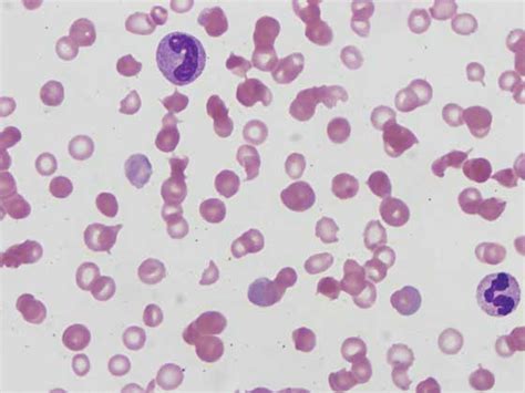 trombositopenik purpura ile çocuklukta hemartroz görülür
